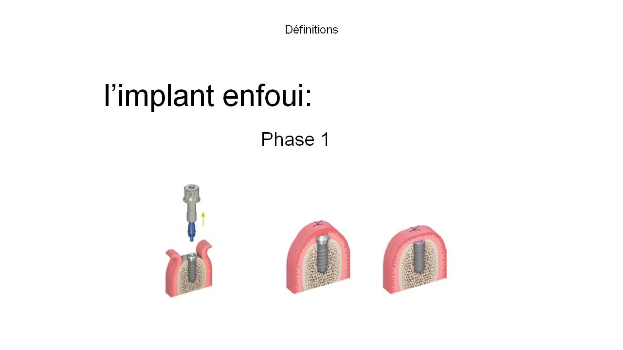 implant pose convenionnelle 5